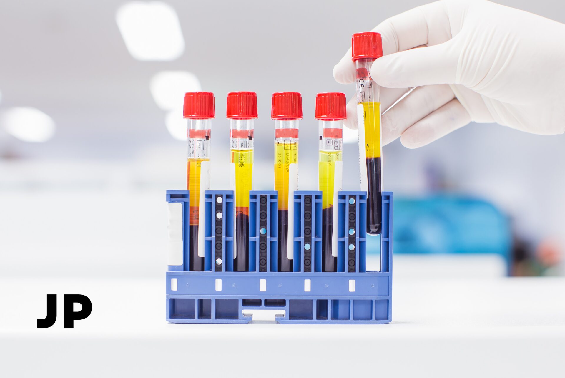 Žemas feritinas ir geležies trūkumas: kaip iš kraujo tyrimų nustatyti tikrąją priežastį