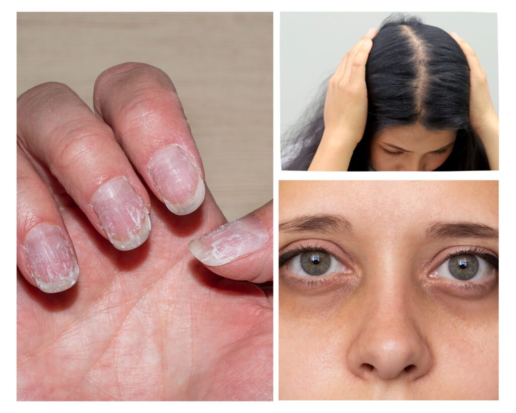 Žemo feritino simptomai, susiję su oda, plaukais ir nagais